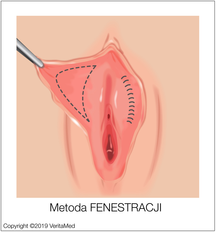 Labioplastyka - Metoda FENESTRACJI - VeritaMed.jpg